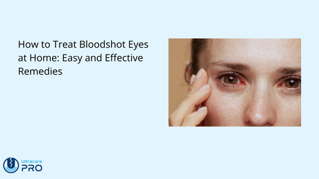how to treat bloodshot eyes at home