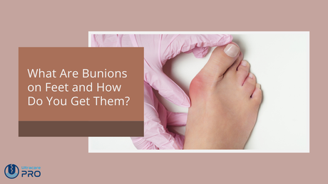 What Are Bunions on Feet and How Do You Get Them?