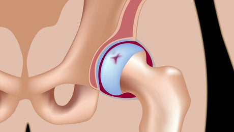 knee replacement