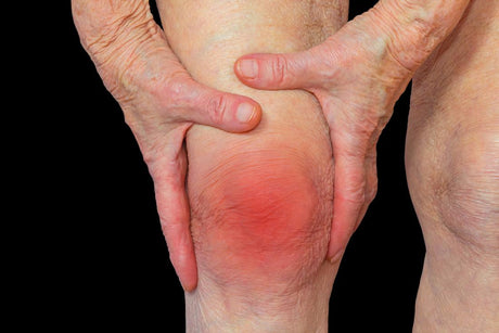 rheumatoid-arthritis-knee