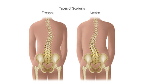 scoliosis-treatment-in-Toronto1