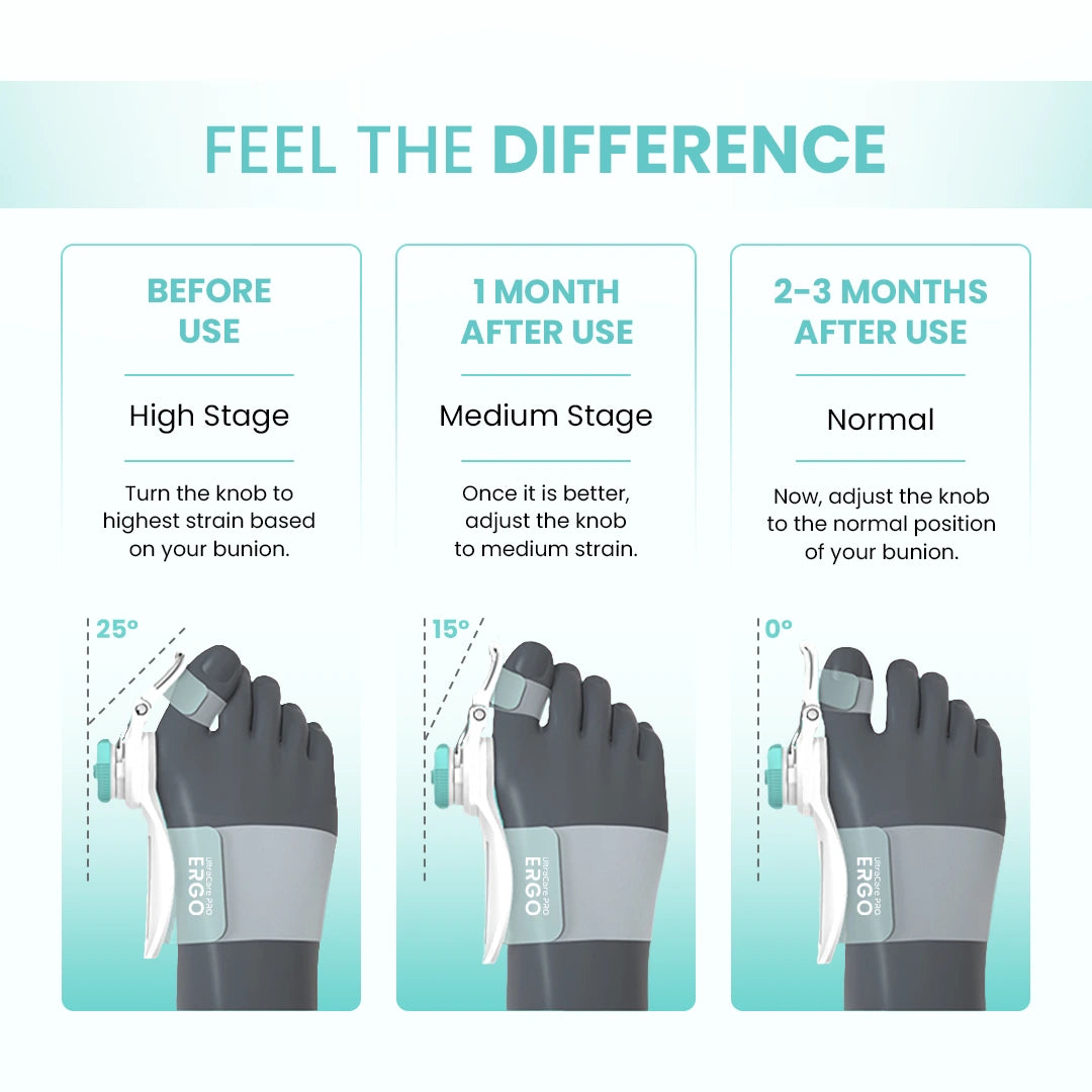 UltraCare PRO bunion corrector showing toe alignment improvement before and after use over time