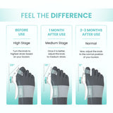 UltraCare PRO bunion corrector showing toe alignment improvement before and after use over time
